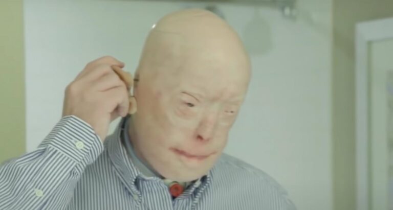 Firefighter suffers third-degree burns – this is him 7 years later