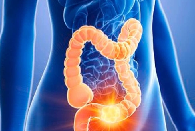 Woman reveals 5 colon cancer symptoms that shouldn’t be ignored