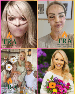 Katie Piper’s Triumph: 17 Years After Acid Attack, She Stuns the World in a Blue Bikini