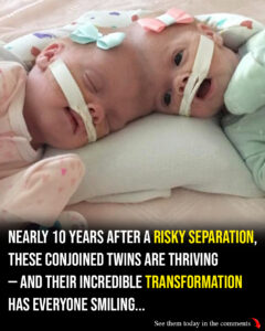 Conjoined twins Abby and Erin Delaney: Inside their remarkable story