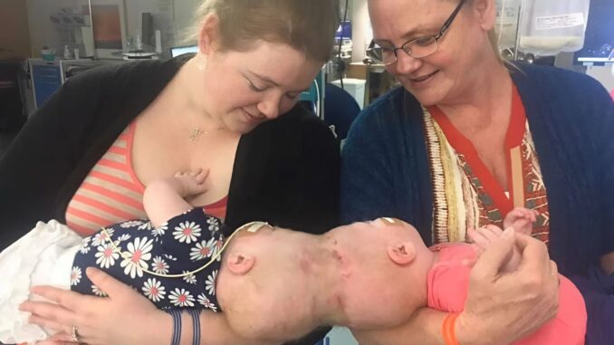 These Siamese sisters were born with their heads