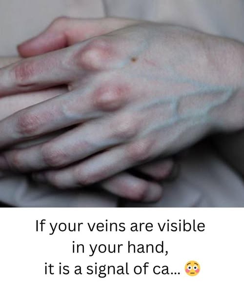 What the Veins on Your Hands Might Reveal About Your Liver Health