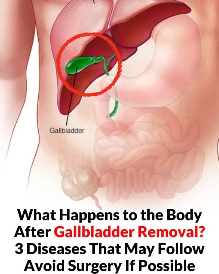 Gallbladder removal: what happens next and 3 risks to watch for