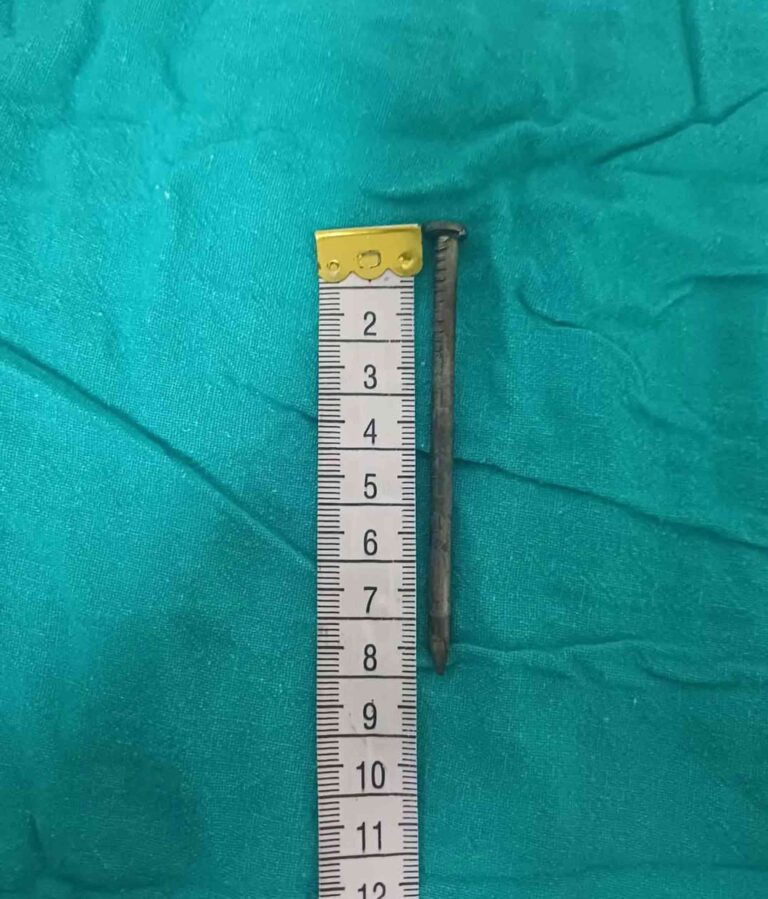 7-Year-Old Boy Gets 3-Inch Nail Lodged in His Brain in Freak Accident While Playing