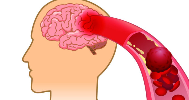 10 signs your arteries might be clogged