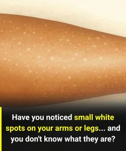 White Spots on Skin: Which Vitamin Deficiencies Could Be the Cause?