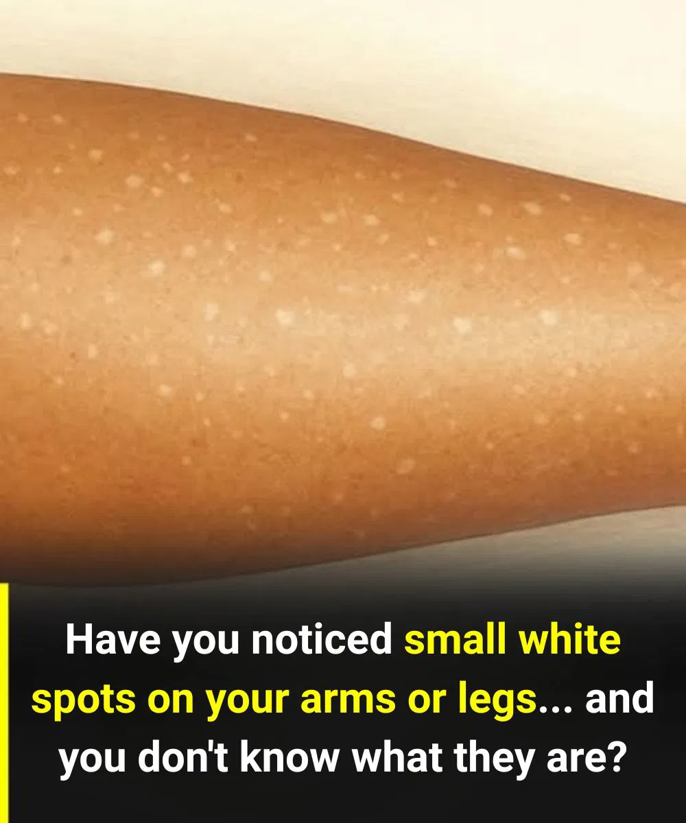 White Spots on Skin: Which Vitamin Deficiencies Could Be the Cause?