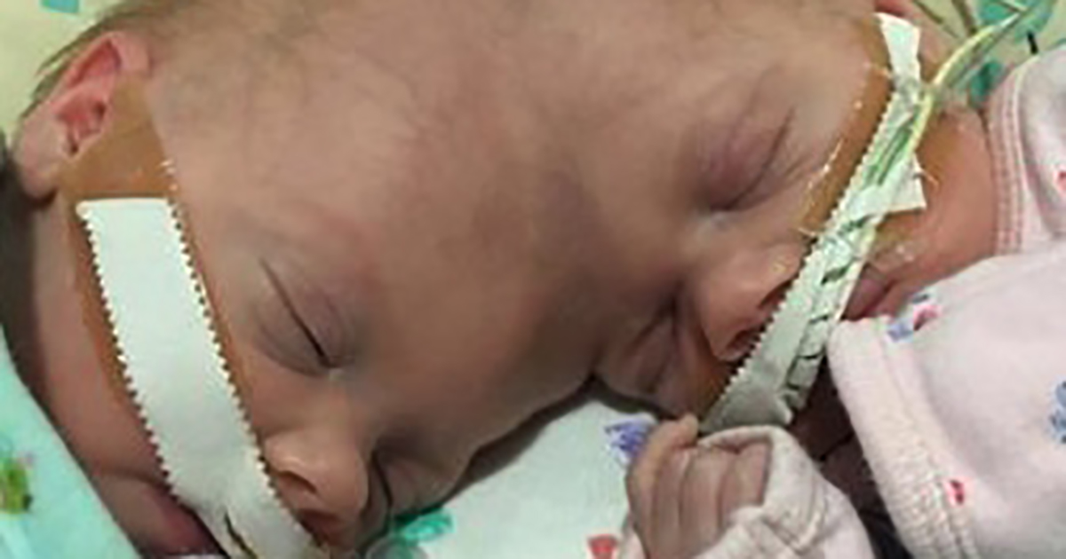 Conjoined twins finally going home to sleep in separate beds after risky surgery