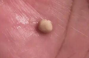 Here’s what you need to know about tonsil stones – the weird pimple-like growths in your throat