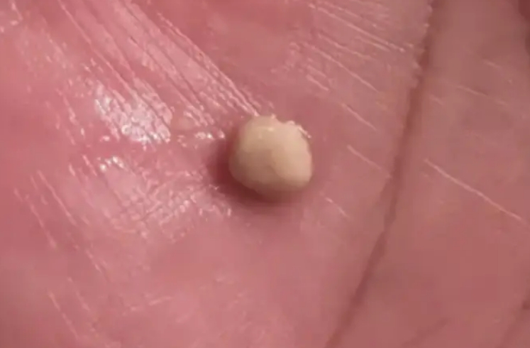 Here’s what you need to know about tonsil stones – the weird pimple-like growths in your throat