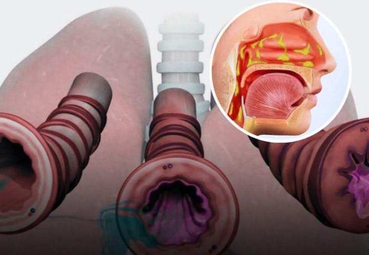 8 Ways To Get Rid Of Phlegm And Mucus In Chest And Throat