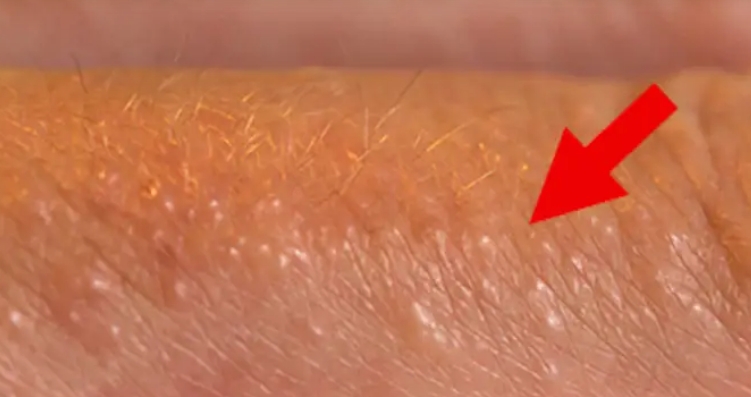 If you see these painful red bumps, you may have dyshidrotic eczema