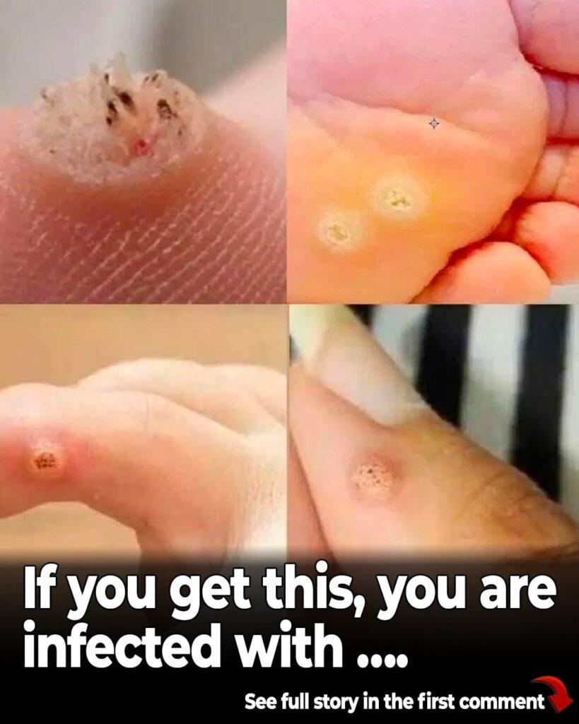 6 Types of Warts (Signs, Symptoms, Home Remedies, and Treatment)