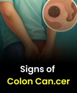 Factors That Increase the Risk of Colon Can:cer