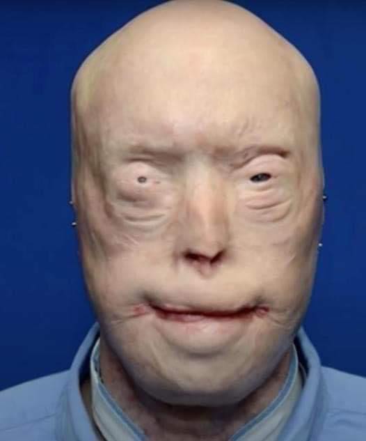 He suffered devastating burns when he tried to rescue a woman trapped in a fire. For years, he was terrified to show his face to the world, and wore caps, sunglasses and prosthetic ears in public. A few years ago, Patrick got the most extensive face transplant ever. I was not ready for how he looks now, and you won’t be either Check 1st comment