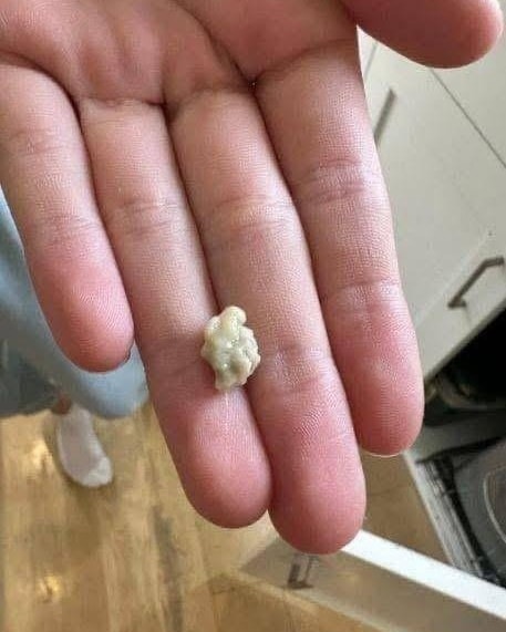 Here’s what you need to know about tonsil stones – the weird pimple-like growths in your throat