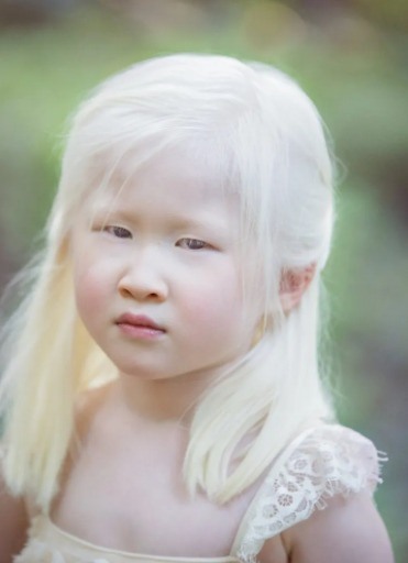 A baby girl born with albinism was abandoned by her parents. She looked too “weird” for them and left her at an orphanage door. Try not to smile when you see her today