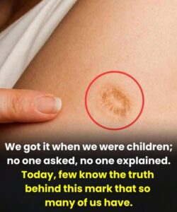 5 Common Misconceptions About the Round Scar on the Upper Arm