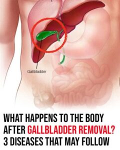 What happens to your body after gallbladder is removed