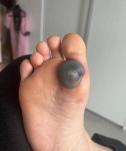 My Daughter Woke Up With a Large, Painful Spot on Her Foot — What It Could Be and What Parents Should Know