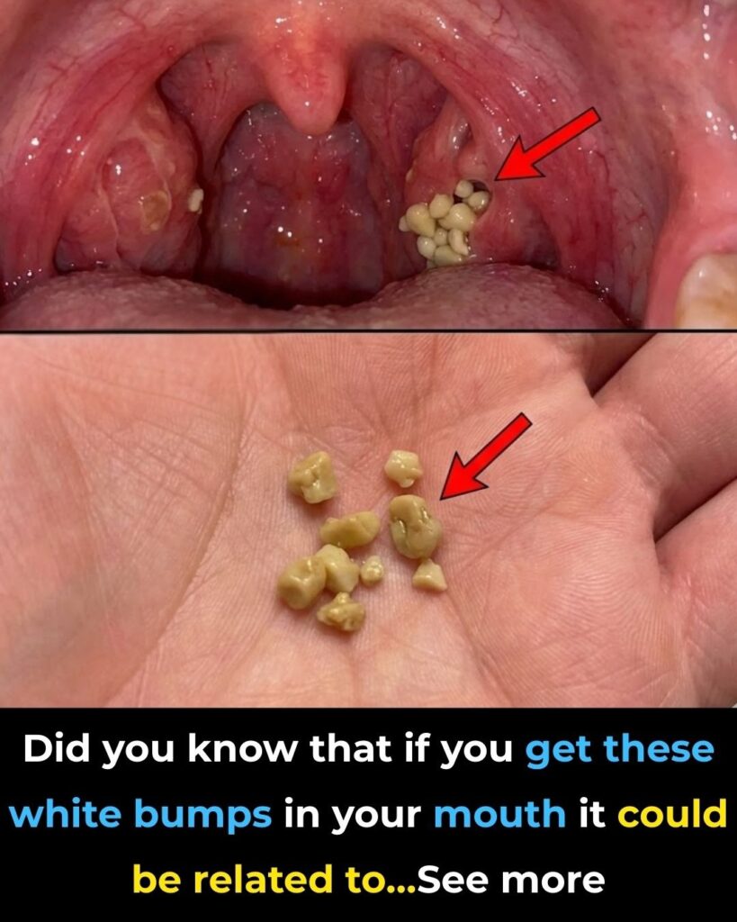 Tonsil Stones: What They Are, How to Spot Them, and How to Get Rid of Them for Good