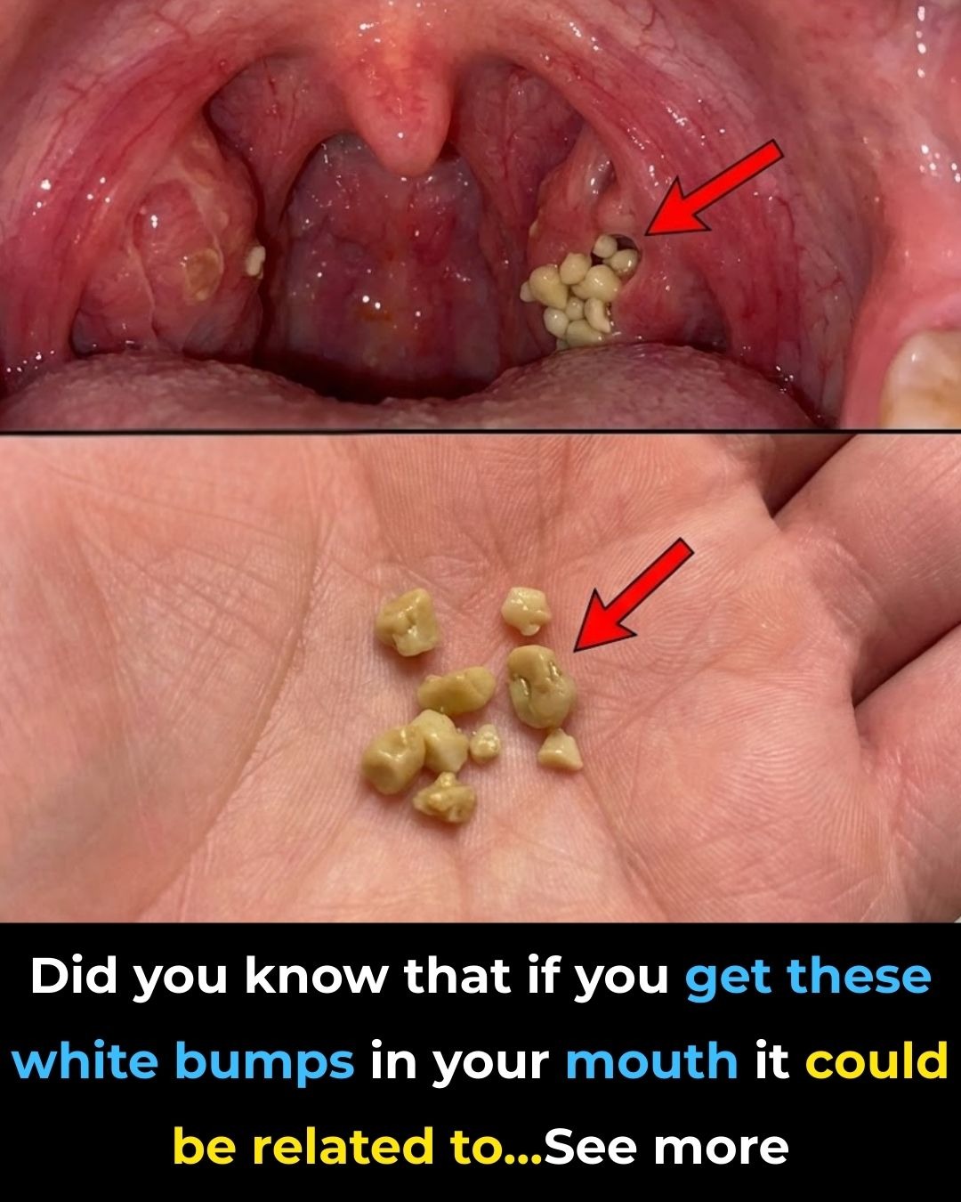 Tonsil Stones: What They Are, How to Spot Them, and How to Get Rid of Them for Good