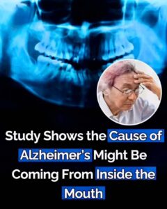 The cause of Alzheimer’s may lie within your mouth