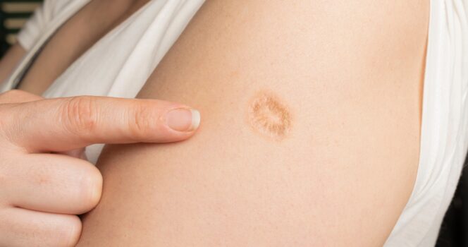 Smallpox vaccine scars: What they look like and why