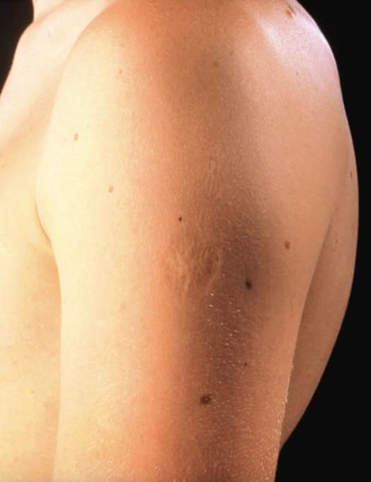 I Found the Smallpox Vaccine Scar What It Means and Why It Matters