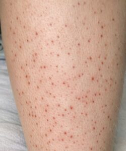 Small red dots keep spreading on my lower legs, and I can’t get checked yet. What can I do now?