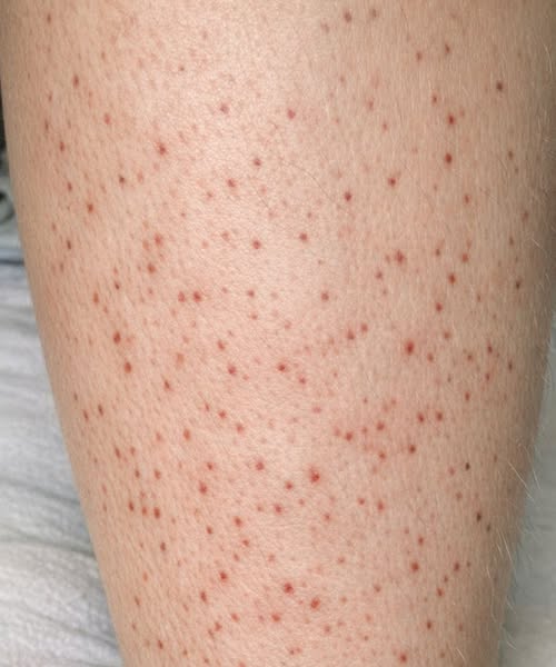 Small red dots keep spreading on my lower legs, and I can’t get checked yet. What can I do now?