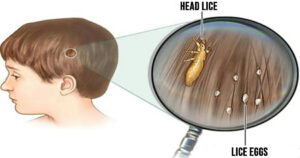 Head lice: How to get rid of them and stop them coming back