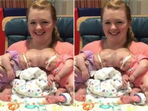 😨😲Once they were joined at the head, two lives in one body. But just look at them now: each lives her own life. From early childhood, these girls showed an amazing synchronicity. 😵 If one smiled, the other would inevitably respond with the same gesture. Parents often said that sometimes it seemed as if they could read each other’s thoughts. 😊 After the separation, each gained her own individuality, but the bond remained — everyone is amazed by this unusual connection. Doctors considered their fate to be difficult, but the determination of the family and modern medical technologies made the impossible possible: the girls were successfully separated. 👨‍👩‍👧 Today, years later, it is hard to believe that they once shared not only space but also every movement. 🧐Full information and photos about the sisters in the first comment.👇👇