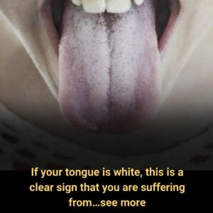 If your tongue is white, this is a clear sign that you are suffering from