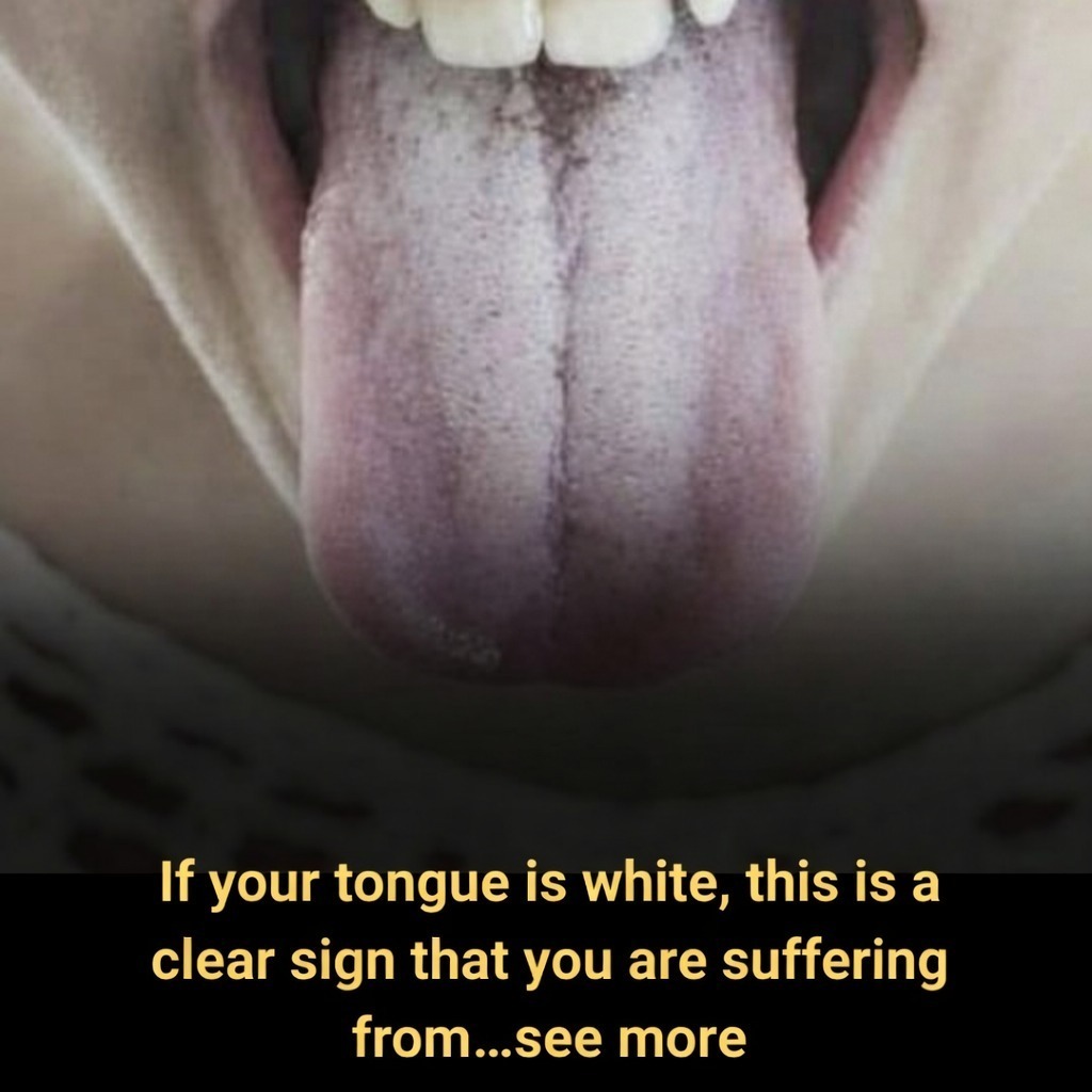 If your tongue is white, this is a clear sign that you are suffering from