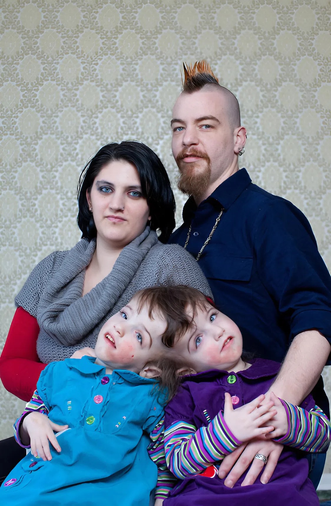 These conjoined twin sisters recently turned 18 😲 They were born with fused heads and partially joined brains 😱 Thanks to that, they can feel, hear, see, and even think for one another. 😲 If one is tickled, the other laughs. If one drinks juice, the other tastes it. 🤔 How the sisters look today was shown in the first comment 👇👇