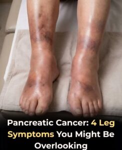 The silent signal: What your swollen legs may reveal about pancreatic cancer