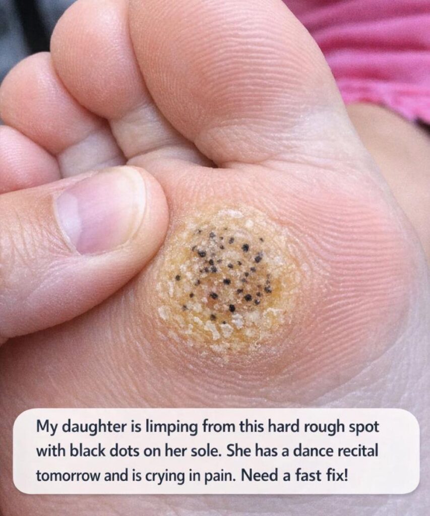 My daughter is limping from this hard rough spot with black dots on her sole. She has a dance recital tomorrow and is crying in pain. Need a fast fix!