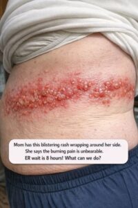 Mom has this blistering rash wrapping around her side. She says the burning pain is unbearable. ER wait is 8 hours! What can we do?