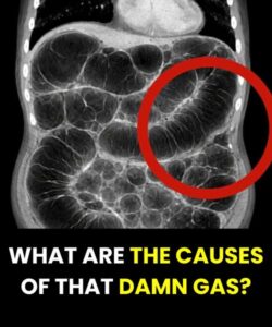 Frequent intestinal gas: the real causes that almost no one explains clearly