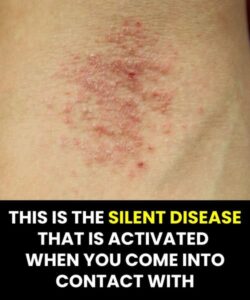 This is the disease that is triggered when the immune system weakens.
