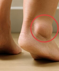 Swollen Feet in Older Adults: Common Causes and Prevention