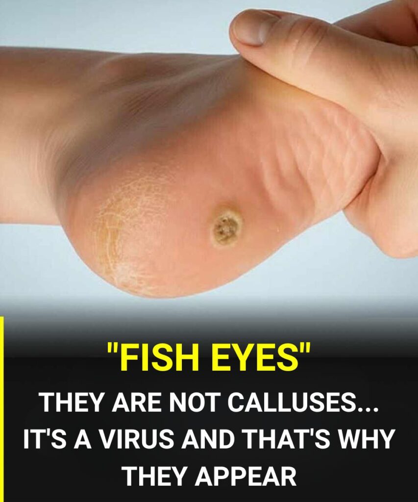 Plantar warts on the feet: what they are and why they shouldn’t be confused with a common callus