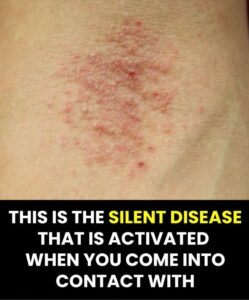 This is the disease that is triggered when the immune system weakens.