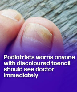 Podiatrist wa.rns anyone with discoloured toenails should see doctor immediately