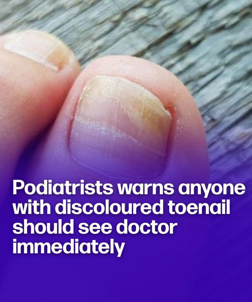 Podiatrist wa.rns anyone with discoloured toenails should see doctor immediately