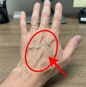 If You Have Visible Veins, Does It Mean Your Circulation Is Poor?