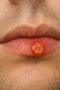 I have a scab on my lip that won’t go away. I can’t get an appointment right now. What is it?