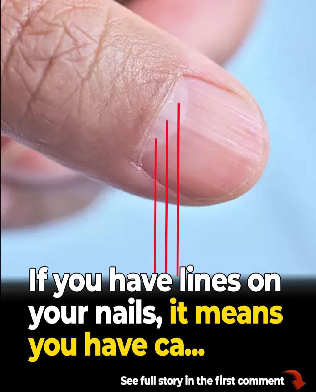 Doctor Uncovers A Telltale Sign In Your Fingernails That May Predict Your Life Expectancy