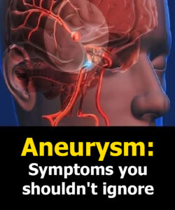 Aneurysm: Signs You Shouldn’t Ignore…